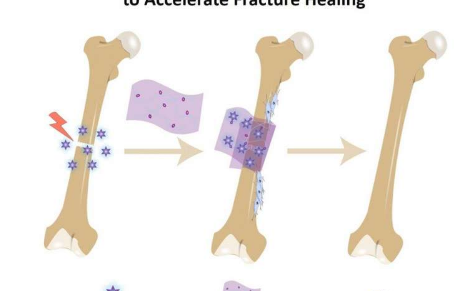骨繃帶吸收修復(fù)性生化物質(zhì)以加速修復(fù)