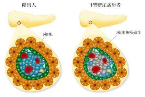 發(fā)現(xiàn)削弱1型糖尿病Treg分化和穩(wěn)定性的新機(jī)制