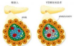 發(fā)現(xiàn)削弱1型糖尿病Treg分化和穩(wěn)定性的新機(jī)制