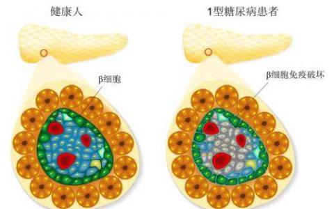 發(fā)現(xiàn)削弱1型糖尿病Treg分化和穩(wěn)定性的新機(jī)制