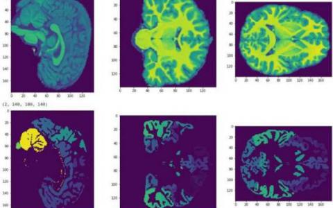 MRI可以進一步據(jù)測青少年大腦發(fā)育