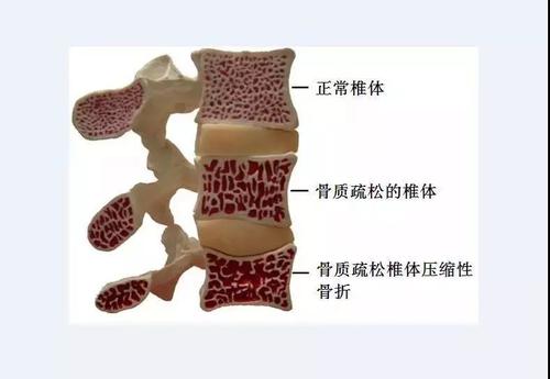 講解早期骨質疏松都有哪些癥狀以及怎么飲食補鈣